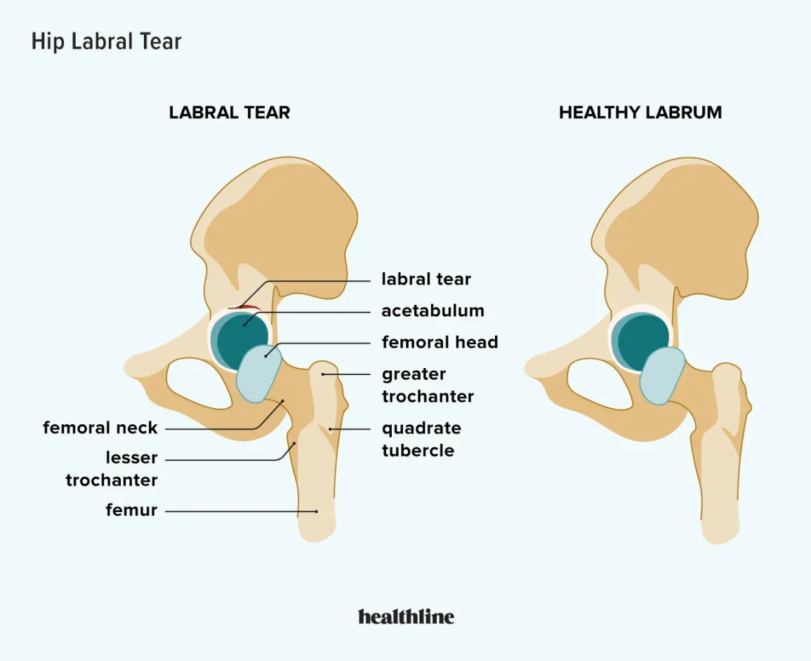 Understanding The Hip Labrum And Hip Labral Tears 8232